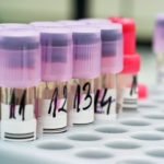 SR (sänka) – vad betyder provsvaret?